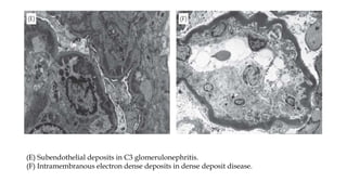 (E) Subendothelial deposits in C3 glomerulonephritis.
(F) Intramembranous electron dense deposits in dense deposit disease.
 