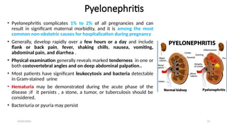 Pyuria Pregnancy The presentation is about common renal disease that leads to acute ...