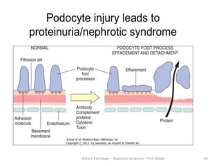 Nephrocity Renal pathology the nephrotic syndrome- prof wadie | PPTX