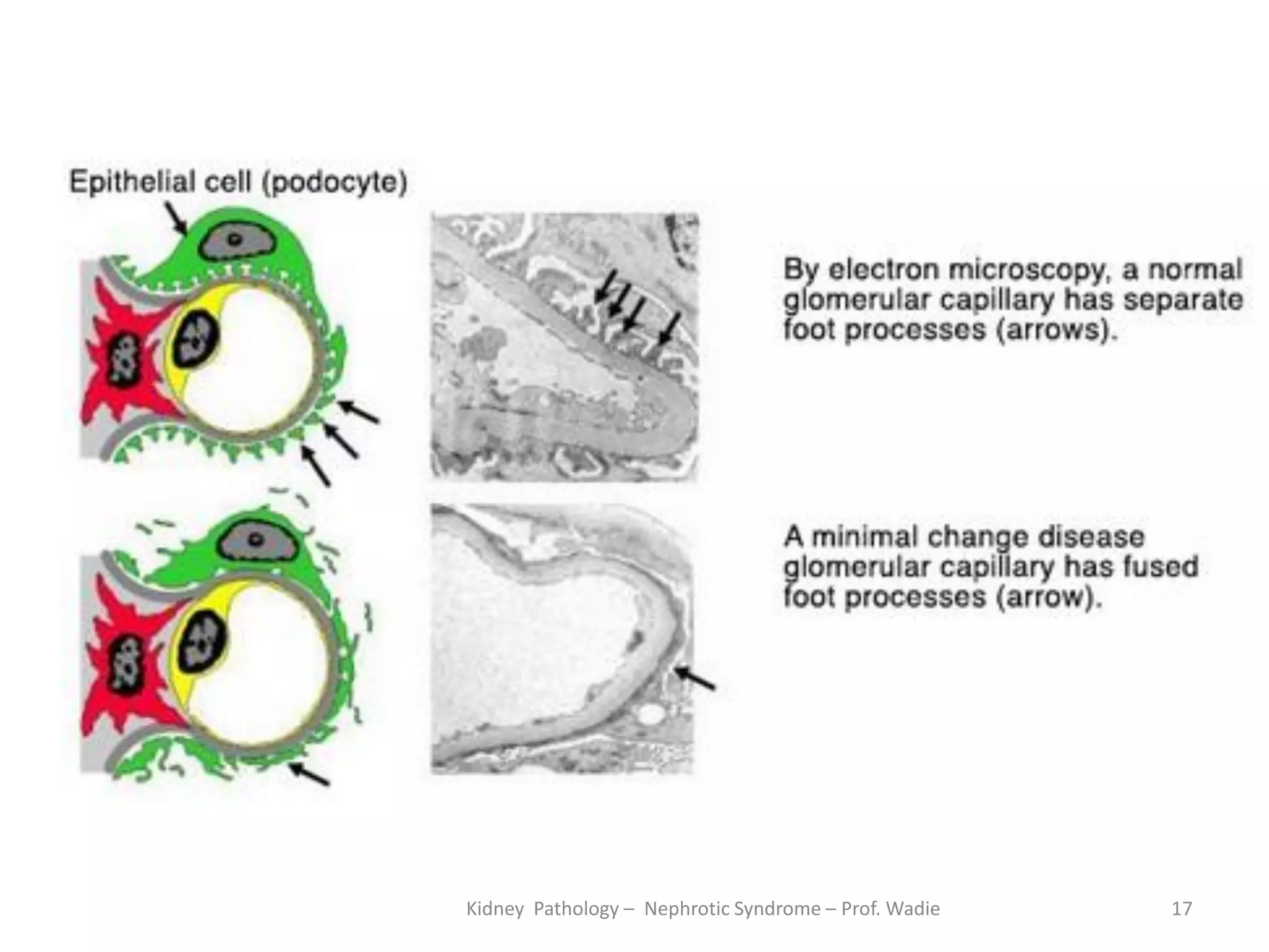 Kidney Pathology – Nephrotic Syndrome – Prof. Wadie 17
 
