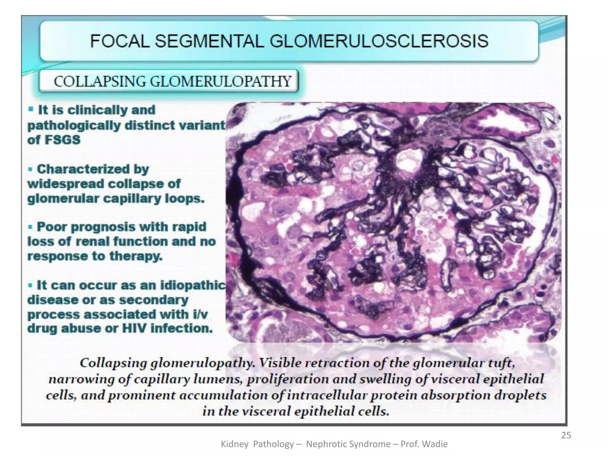 Kidney Pathology – Nephrotic Syndrome – Prof. Wadie
25
 