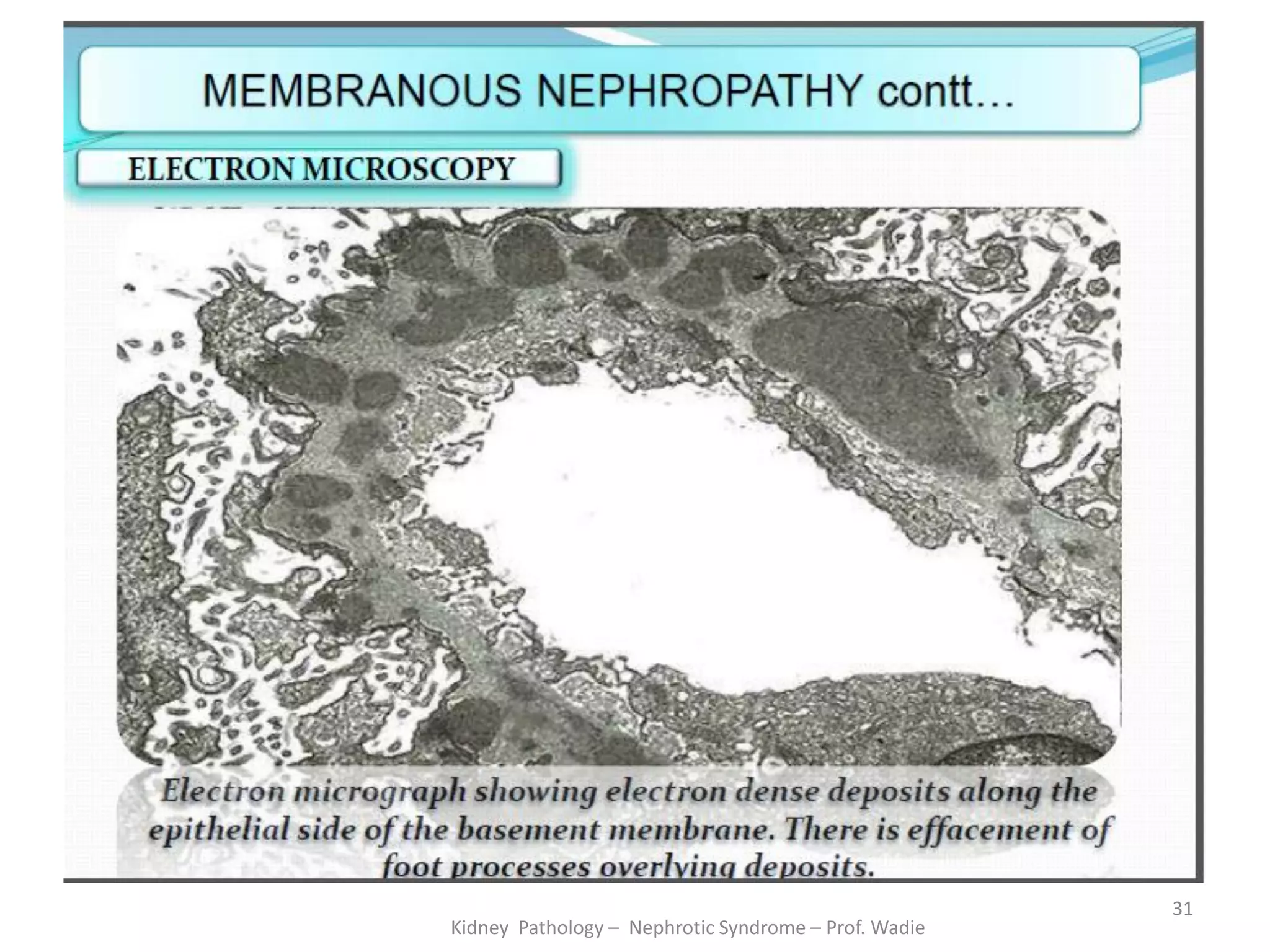 Kidney Pathology – Nephrotic Syndrome – Prof. Wadie
31
 