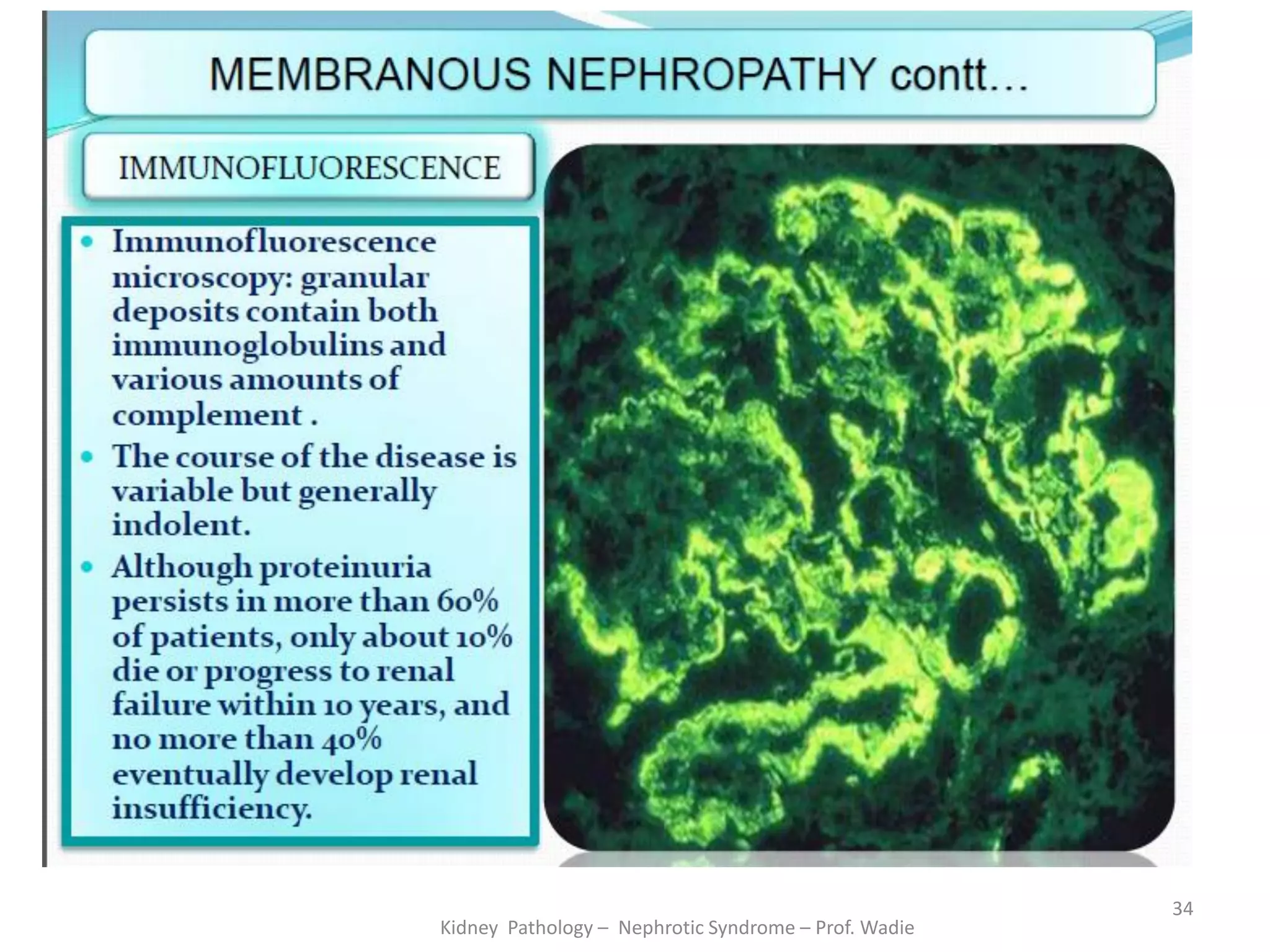 Kidney Pathology – Nephrotic Syndrome – Prof. Wadie
34
 