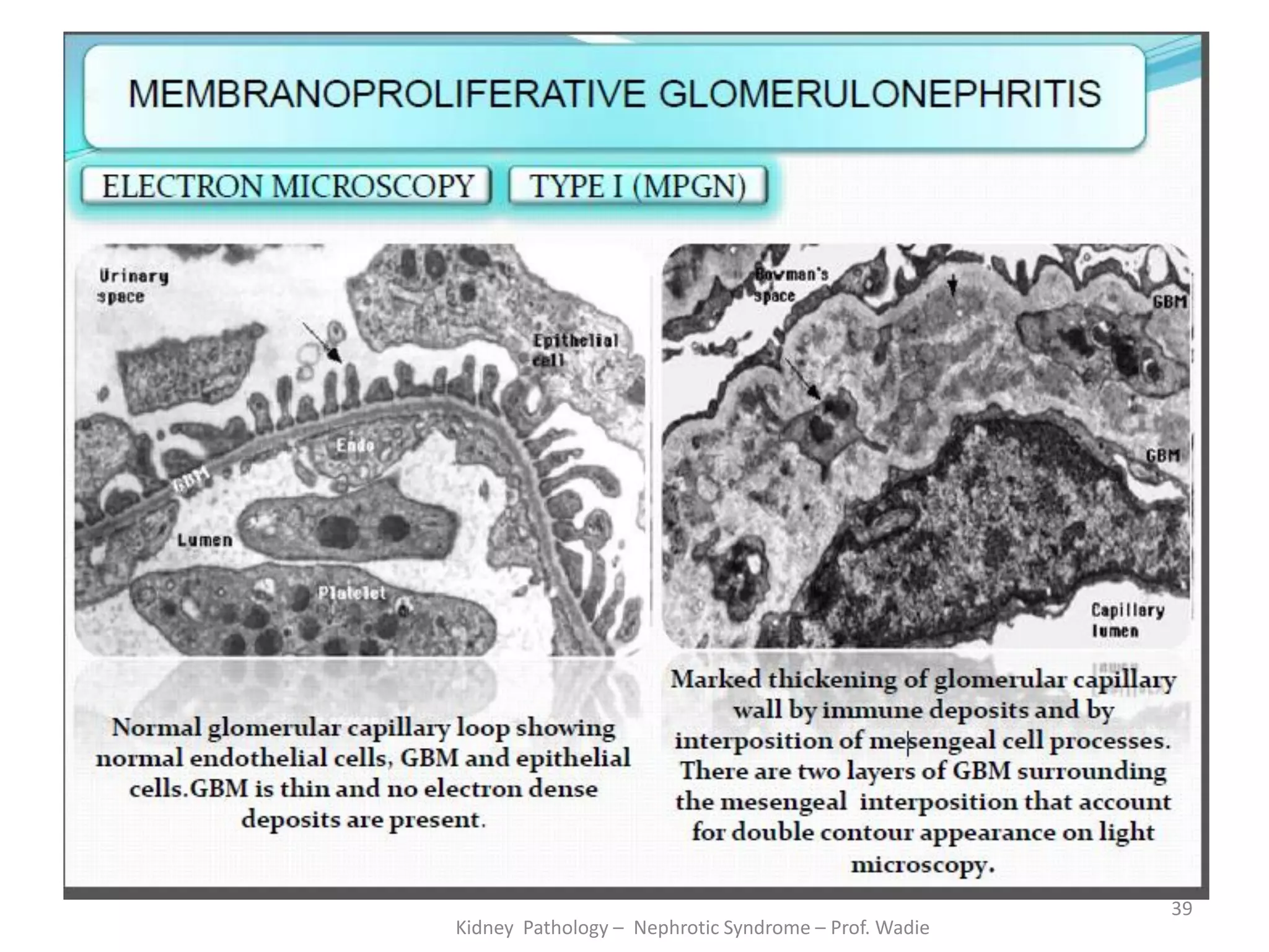 Kidney Pathology – Nephrotic Syndrome – Prof. Wadie
39
 