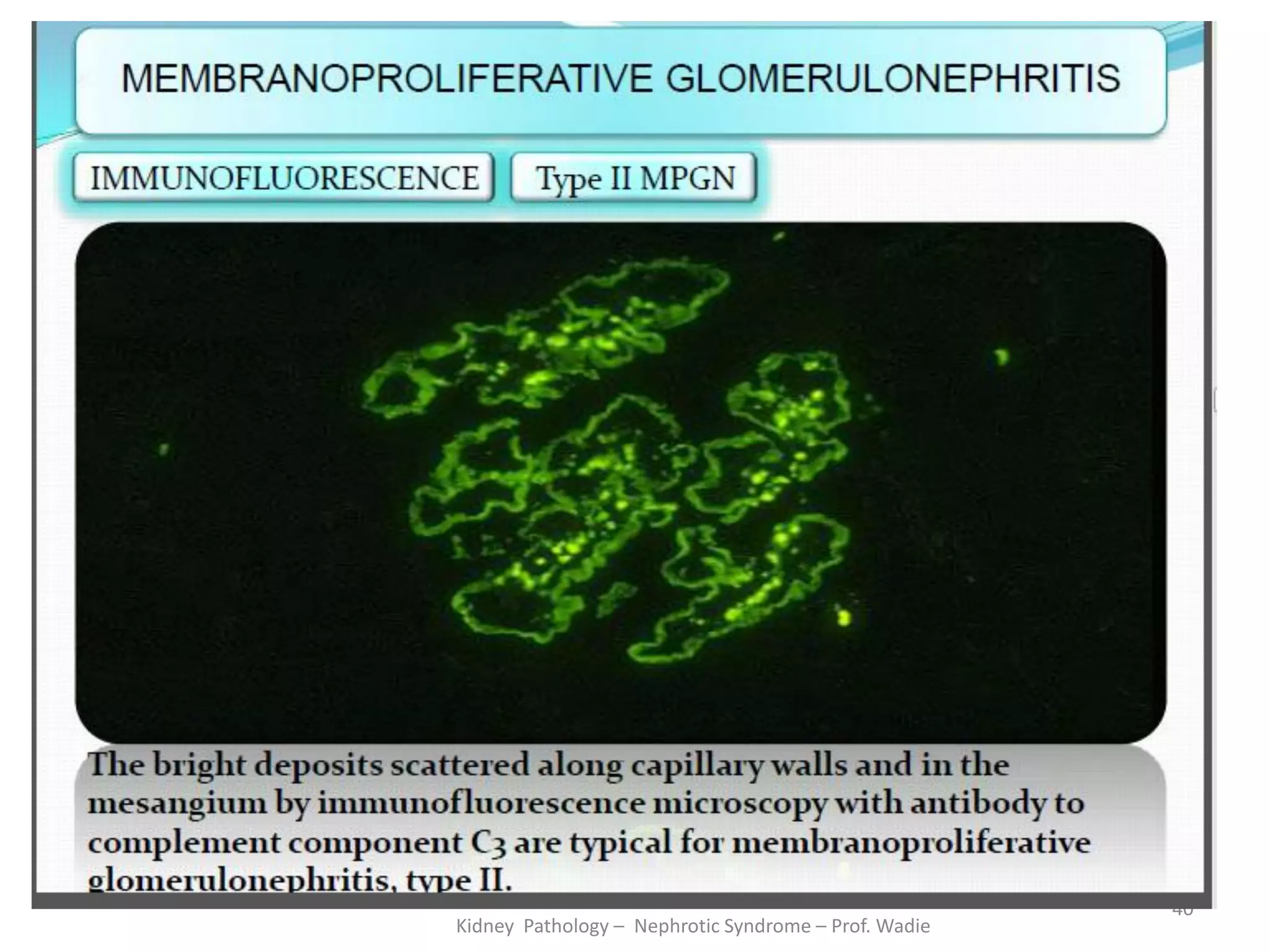 Kidney Pathology – Nephrotic Syndrome – Prof. Wadie
40
 
