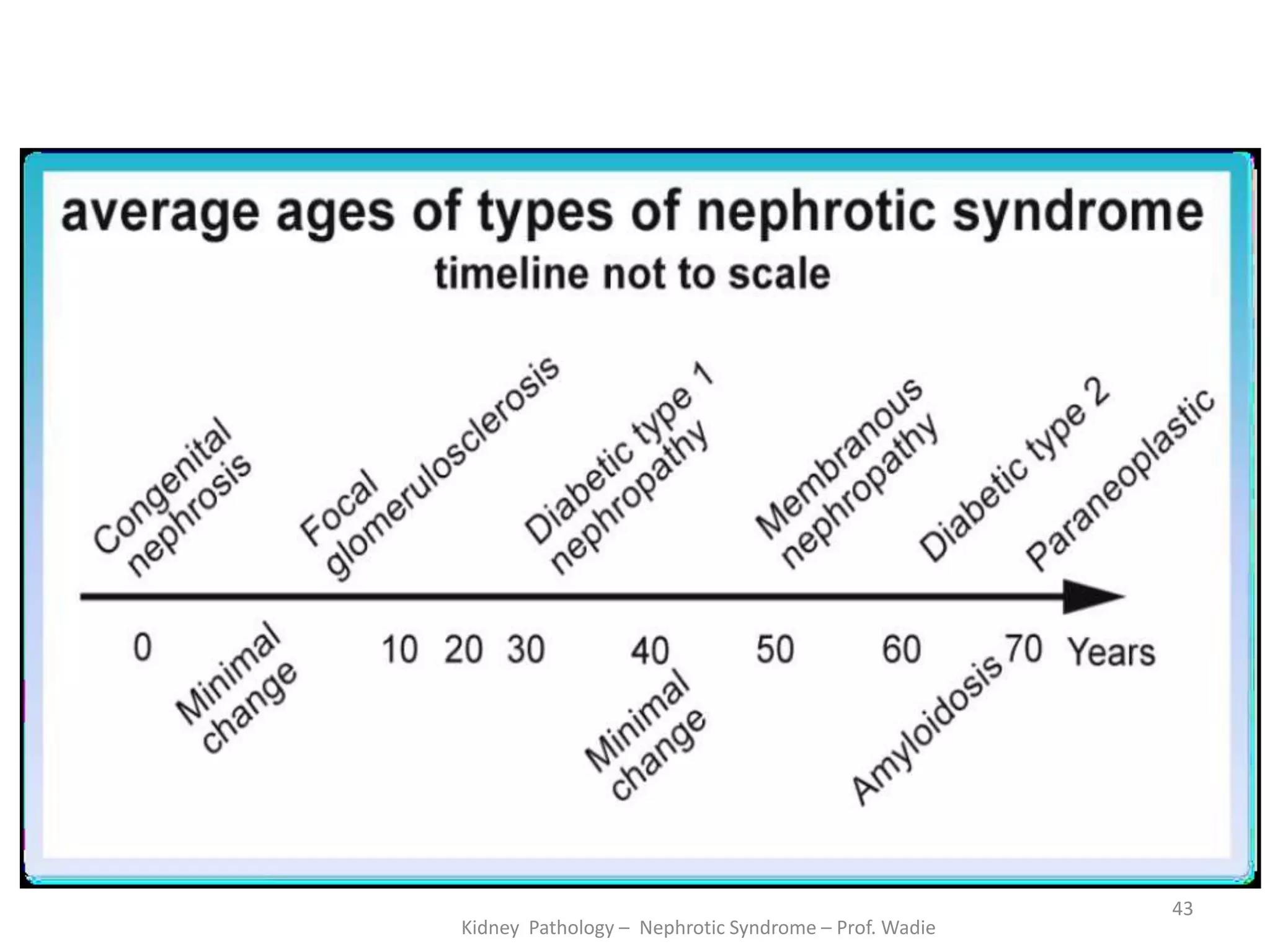 Kidney Pathology – Nephrotic Syndrome – Prof. Wadie
43
 
