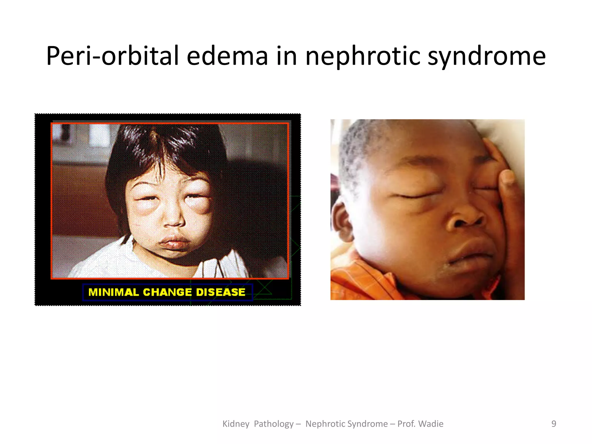Peri-orbital edema in nephrotic syndrome
Kidney Pathology – Nephrotic Syndrome – Prof. Wadie 9
 