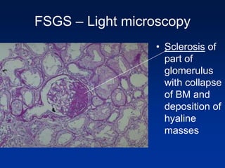 FSGS – Light microscopy
• Sclerosis of
part of
glomerulus
with collapse
of BM and
deposition of
hyaline
masses
 