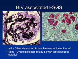 HIV associated FSGS
• Left – Silver stain sclerotic involvement of the entire tuft
• Right – Cystic dilatation of tubules with proteinaceous
material
 