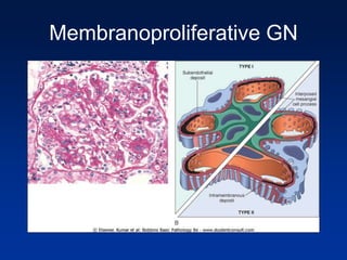 Membranoproliferative GN
 