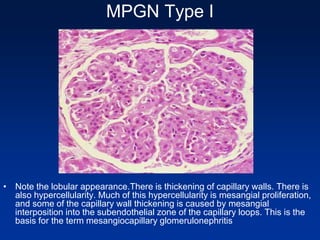 MPGN Type I
• Note the lobular appearance.There is thickening of capillary walls. There is
also hypercellularity. Much of this hypercellularity is mesangial proliferation,
and some of the capillary wall thickening is caused by mesangial
interposition into the subendothelial zone of the capillary loops. This is the
basis for the term mesangiocapillary glomerulonephritis
 
