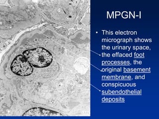 MPGN-I
• This electron
micrograph shows
the urinary space,
the effaced foot
processes, the
original basement
membrane, and
conspicuous
subendothelial
deposits
 