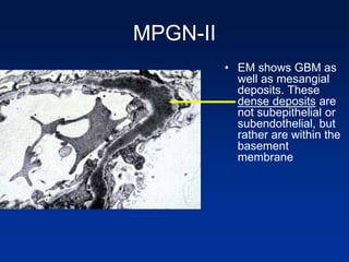 MPGN-II
• EM shows GBM as
well as mesangial
deposits. These
dense deposits are
not subepithelial or
subendothelial, but
rather are within the
basement
membrane
 