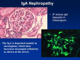 IgA Nephropathy
. The IgA is deposited mainly in
mesangium, which then
increases mesangial cellularity
as shown at the arrow.
• IF shows IgA
deposits in
mesangium
 