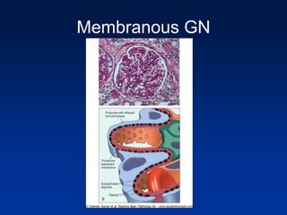 Membranous GN
 