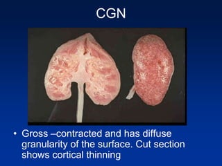 CGN
• Gross –contracted and has diffuse
granularity of the surface. Cut section
shows cortical thinning
 