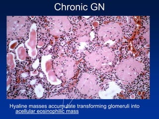 Chronic GN
Hyaline masses accumulate transforming glomeruli into
acellular eosinophilic mass
 