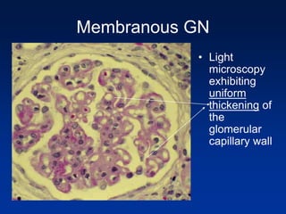 Membranous GN
• Light
microscopy
exhibiting
uniform
thickening of
the
glomerular
capillary wall
 