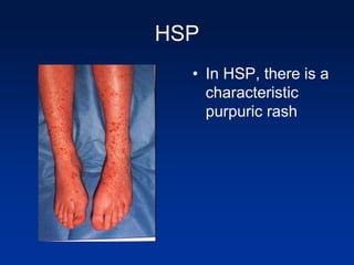 HSP
• In HSP, there is a
characteristic
purpuric rash
 