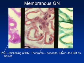 Membranous GN
PAS –thickening of BM, Trichrome – deposits, Silver –the BM as
Spikes
 