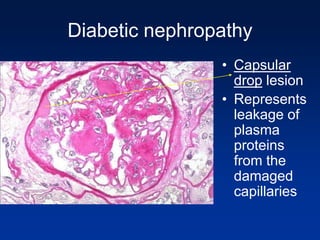Diabetic nephropathy
• Capsular
drop lesion
• Represents
leakage of
plasma
proteins
from the
damaged
capillaries
 