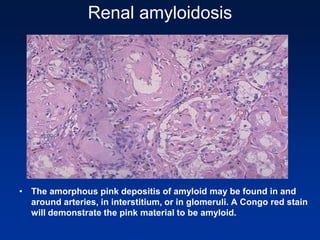 Renal amyloidosis
• The amorphous pink depositis of amyloid may be found in and
around arteries, in interstitium, or in glomeruli. A Congo red stain
will demonstrate the pink material to be amyloid.
 