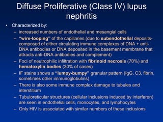 Diffuse Proliferative (Class IV) lupus
nephritis
• Characterized by:
– increased numbers of endothelial and mesangial cells
– “wire-looping” of the capillaries (due to subendothelial deposits-
composed of either circulating immune complexes of DNA + anti-
DNA antibodies or DNA deposited in the basement membrane that
attracts anti-DNA antibodies and complement)
– Foci of neutrophilic infiltration with fibrinoid necrosis (70%) and
hematoxylin bodies (30% of cases)
– IF stains shows a “lumpy-bumpy” granular pattern (IgG, C3, fibrin,
sometimes other immunoglobulins)
– There is also some immune complex damage to tubules and
interstitium
– Tubuloreticular structures (cellular inclusions induced by interferon)
are seen in endothelial cells, monocytes, and lymphocytes
– Only HIV is associated with similar numbers of these inclusions
 
