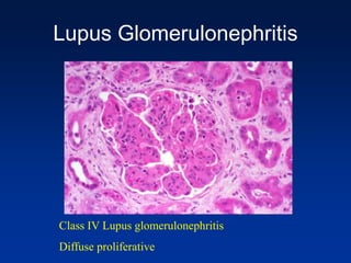 Class IV Lupus glomerulonephritis
Diffuse proliferative
Lupus Glomerulonephritis
 
