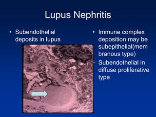 Lupus Nephritis
• Subendothelial
deposits in lupus
• Immune complex
deposition may be
subepithelial(mem
branous type)
• Subendothelial in
diffuse proliferative
type
 