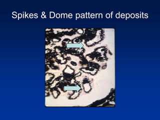 Spikes & Dome pattern of deposits
 