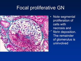Focal proliferative GN
• Note segmental
proliferation of
cells with
necrosis and
fibrin deposition.
The remainder
of glomerulus is
uninvolved
 