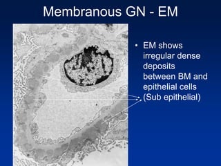 Membranous GN - EM
• EM shows
irregular dense
deposits
between BM and
epithelial cells
(Sub epithelial)
 