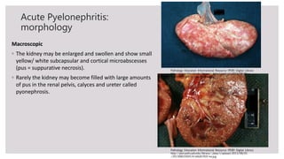 Renal pathology lecture 2&3. Infection of upper and lower urinary tract ...