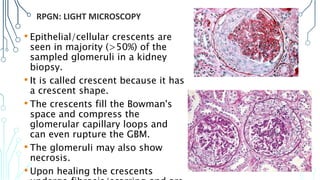 Crescentic Rpgn Renal pathology lecture 6 Rapid Progressive Glomerulonephritis ...