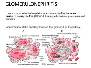 GLOMERULONEPHRITIS
• encompasses a subset of renal diseases characterized by immune-
mediated damage to the glomeruli leading to hematuria, proteinuria, and
azotemia
• inflammation of the capillary loops in the glomeruli of the kidney.
 