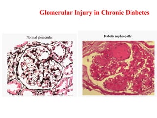 Glomerular Injury in Chronic Diabetes
 