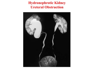 Hydronephrotic Kidney
Ureteral Obstruction
 