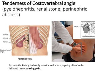 Tenderness of Costovertebral angle
(pyelonephritis, renal stone, perinephric
abscess)
Because the kidney is directly anterior to this area, tapping disturbs the
inflamed tissue, causing pain.
 