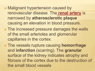  Malignant hypertension caused by
  renovascular disease. The renal artery is
  narrowed by atherosclerotic plaque
  causing an elevation in blood pressure.
 The increased pressure damages the walls
  of the small arterioles and glomerular
  capillaries in the cortex.
 The vessels rupture causing hemorrhage
  and infarction (scarring). The granular
  surface of the kidney indicates atrophy and
  fibrosis of the cortex due to the destruction of
  the small blood vessels
 