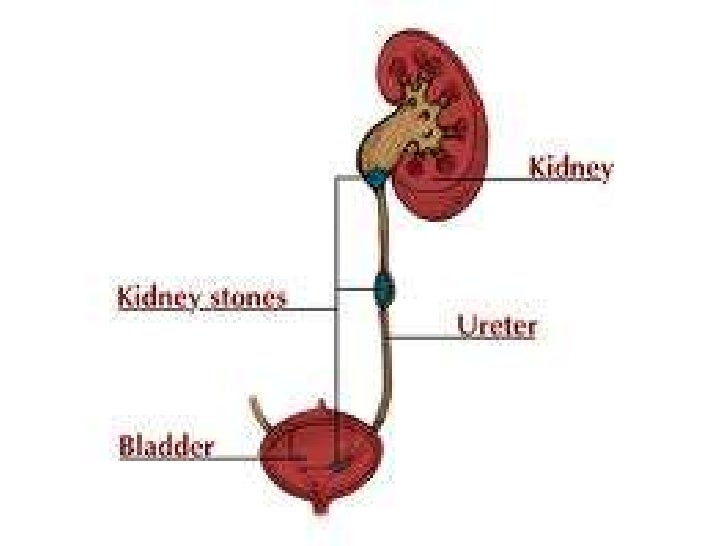 renal calculus renal calculus