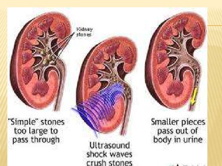 Renal calculi