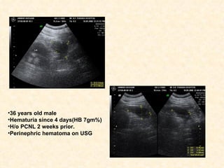 Embolisation for a post PCNL renal pseudoaneurysm. | PPT