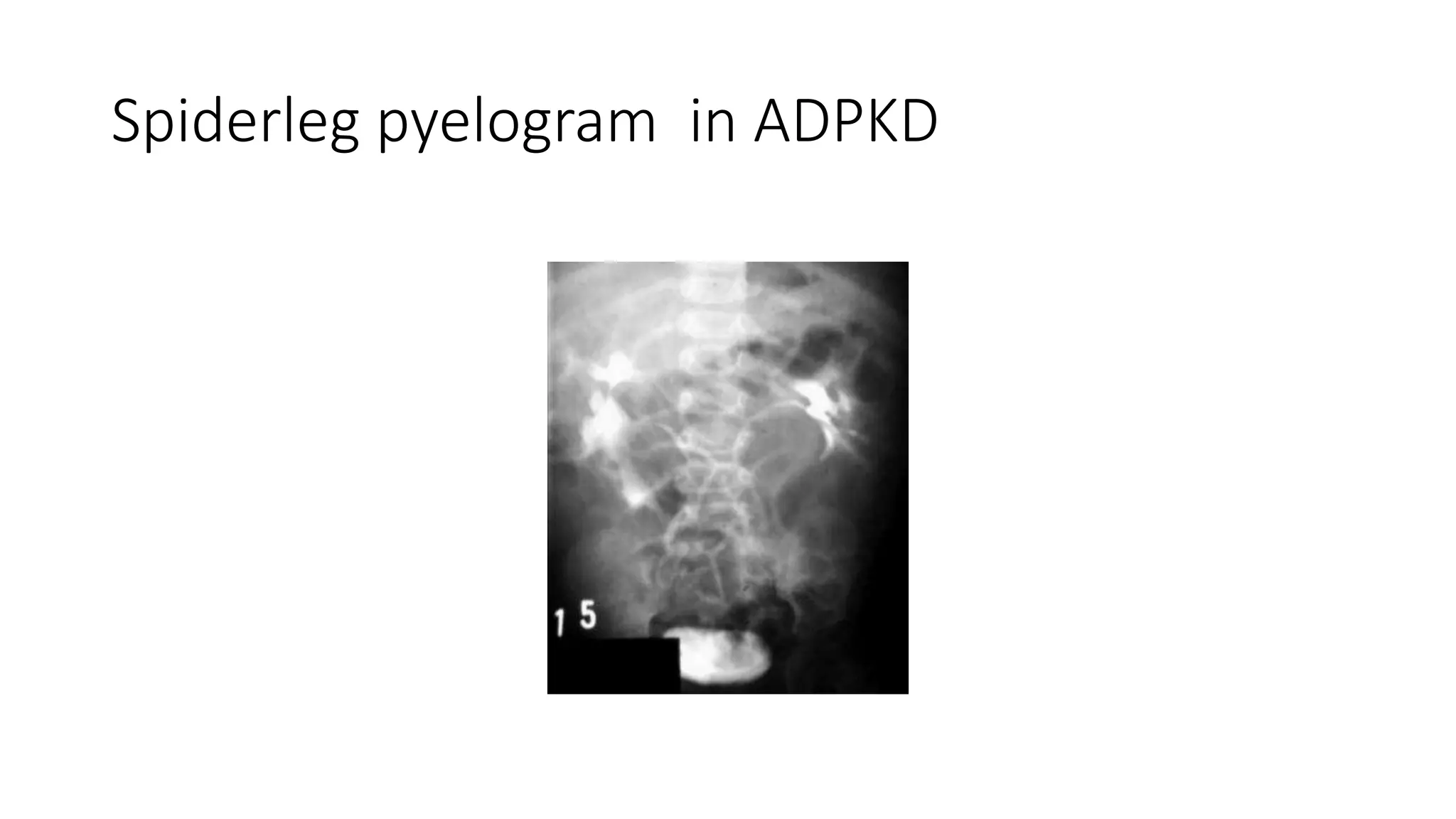 Pyelongram Renal radiology revision notes | PDF