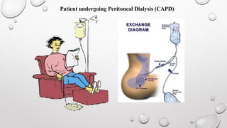 Patient undergoing Peritoneal Dialysis (CAPD) 
 