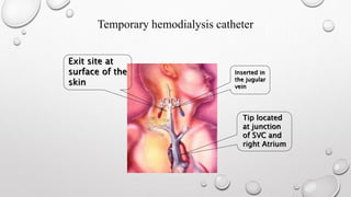 Temporary hemodialysis catheter 
Exit site at 
surface of the 
skin 
Inserted in 
the jugular 
vein 
Tip located 
at junction 
of SVC and 
right Atrium 
 