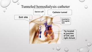 Tunneled hemodialysis catheter 
Exit site 
Catheter tunnel 
Inserted in 
the jugular 
vein 
Tip located 
at junction 
of SVC and 
right Atrium 
Dacron cuff 
 