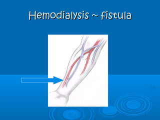 Hemodialysis ~ fistulaHemodialysis ~ fistula
 