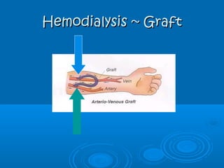 Hemodialysis ~ GraftHemodialysis ~ Graft
 