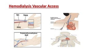 Hemodialysis Vascular Access
Polytetrafluoroethylene
 
