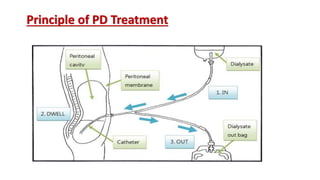 Principle of PD Treatment
 